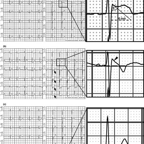 (a) Baseline electrocardiogram depicting type‐2 Brugada ECG pattern ...