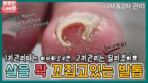 Fixing a severely curved toenail. So satisfying. : r/popping