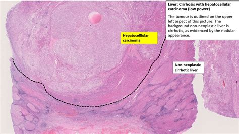 Cirrhosis Histology