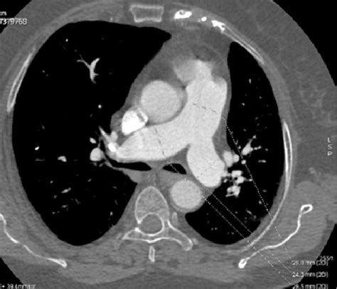 Pulmonary Computed Tomography Angiogram Axial Plane Medical Cement