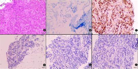 Frontiers The Diagnostic Value And Safety Of Modified Needle Aspiration Biopsy For Superficial