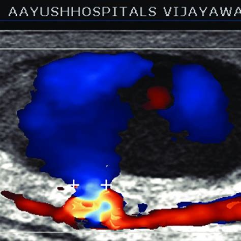 Flow In The Radial Artery Pseudoaneurysm Download Scientific Diagram