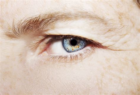 Baggy Eyelids: Dermatochalasis Symptoms & Treatment - Grosinger, Spigelman & Grey