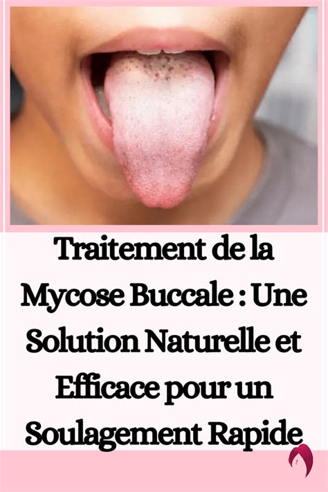 Traitement De La Mycose Buccale Une Solution Naturelle