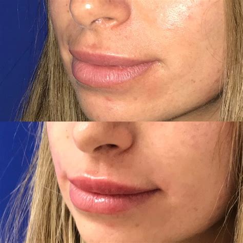 Restylane Kysse Lip Fillers In Santa Rosa And Healdsburg