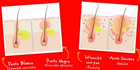 15 Infográficos Para Combatir El Acné De Una Vez Por Todas