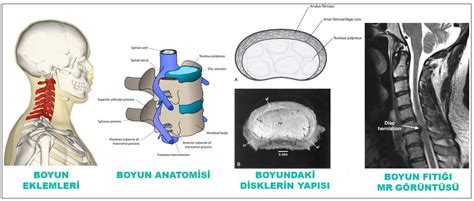 Boyun Fıtığı Kadıköy Fizik Tedavi Manuel Terapi