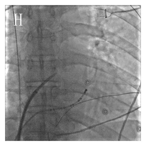 Transseptal Puncture With Fluoroscopy A At The Right Anterior