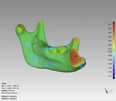 A Revised Approach For Mandibular Reconstruction With The Vascularized Iliac Crest Flap Using