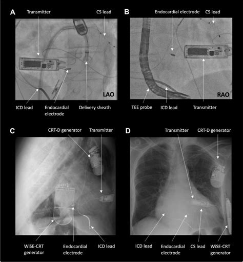 Feasibility Of Leadless Left Ventricular Septal Pacing With The Wise