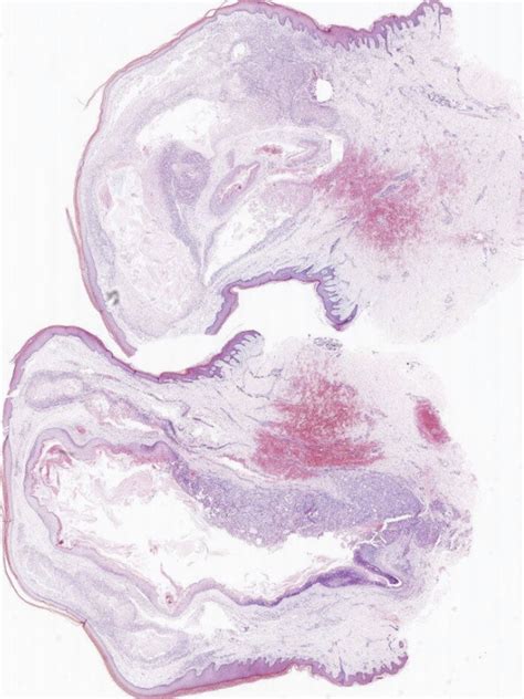 Case 1 54 Yo Female Buttock Lesion Kiko Xp