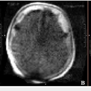 Portable MRI of the brain without intravenous contrast. Portable MRI of ...