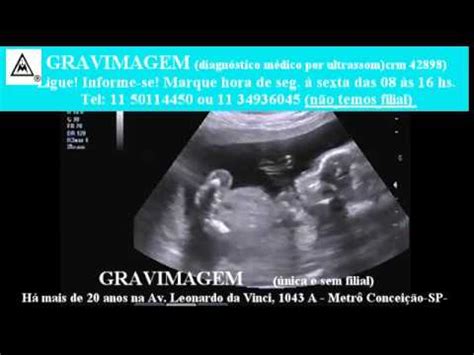 Gravimagem Ultrassom Morfol Gico Em Gravidez Semana Youtube