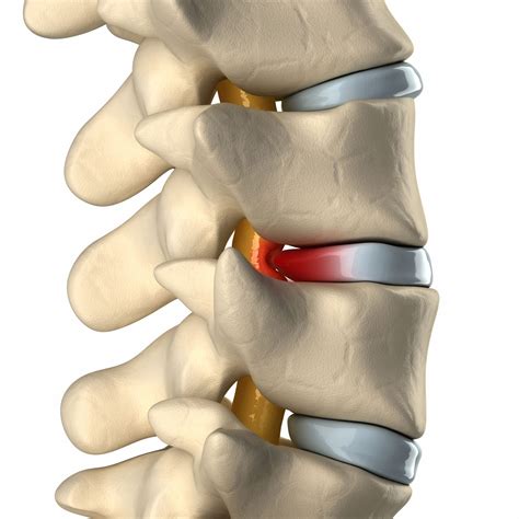 CERVICAL HERNIATED DISC - MOTUS Physical Therapy