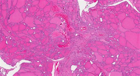 Malattia Nodulare Follicolare Della Tiroide Mypathologyreport Ca