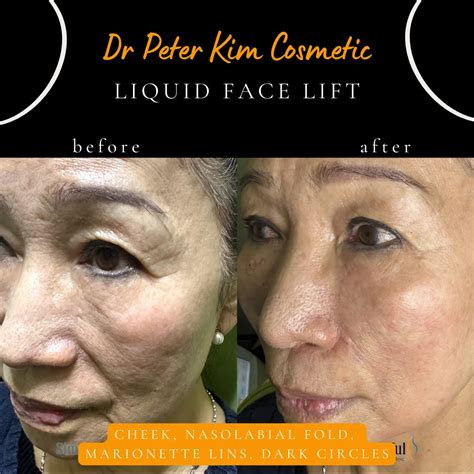 Cosmetic Dermal Filler Injection Dr Peter Kim Surgery Skin Cancer