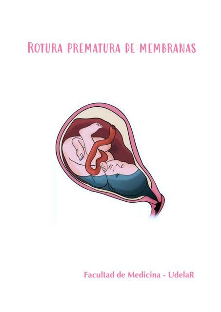 Rotura Prematura De Membranas Ovulares Nina Navatta Udocz