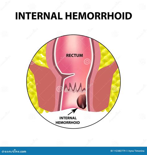 Rectum Diagram