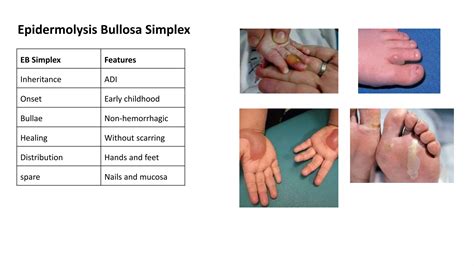 Epidermolysis Bullosa Ppt