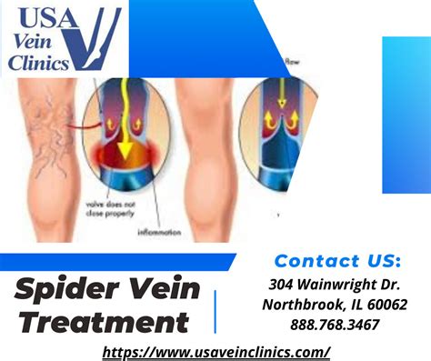 Spider Vein Treatment Our Primary Goal Of Spider Vein Trea… Flickr