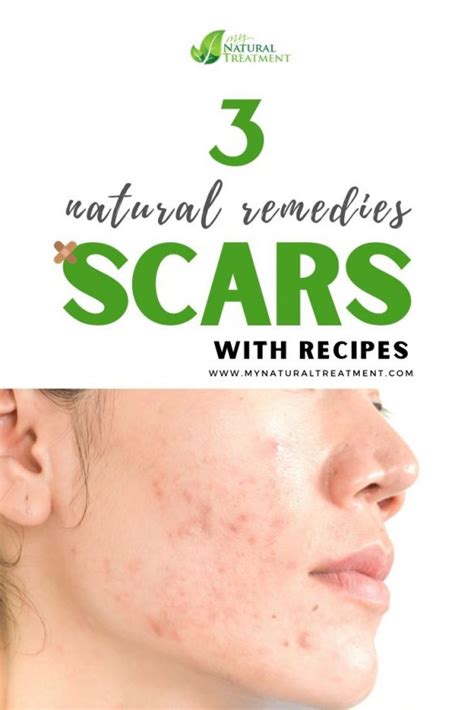 3 Natural Remedies for Scars that Work - Scar Tissue