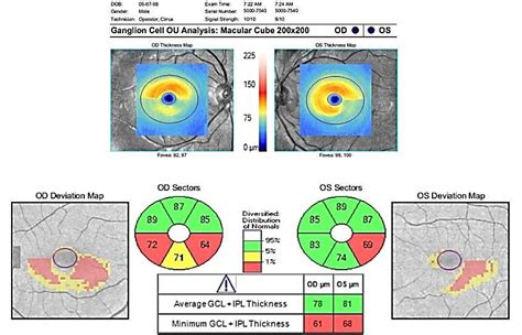 El Protocolo Cirrus Hd Oct Macular Cube 200 × 200 Proporciona Un