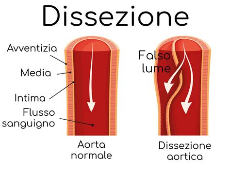 Dissezione Aortica Cause Sintomi Pericoli E Cura