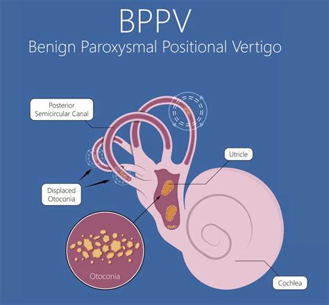 Benign Paroxysmal Positional Vertigo Bppv Is One Of The Most Common