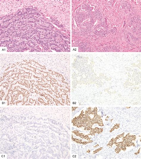 This Rectal Well Differentiated Neuroendocrine Tumor That Metastasized Download Scientific