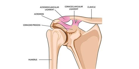 Luxación acromioclavicular ¿en qué consiste? • Dr. Miguel Romero