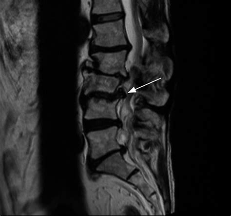 Dialecto Aire Carbohidrato Cuales Son Las Vertebras L Y L Off