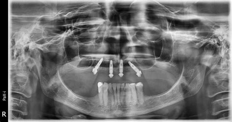 Em Tempos De Cursos De Implantes Zigom Ticos Pterig Ides Transnasais