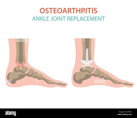 Arthritis Osteoarthritis Medical Infographic Design Joint Replacement