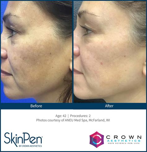 Microneedling Collagen Stimulation Essex Skin Enhance Clinic