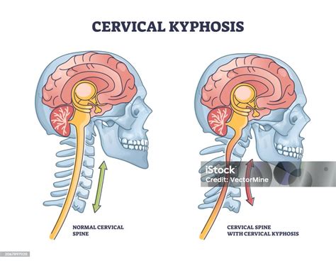 Cervical Kyphosis Condition With Spine And Neck Curvature Outline