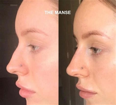 Non Surgical Rhinoplasty Best Clinic Sydney For Dermal Fillers