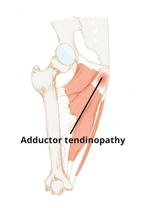 Groin Pain How To Deal With Them Elevate Physiotherapy