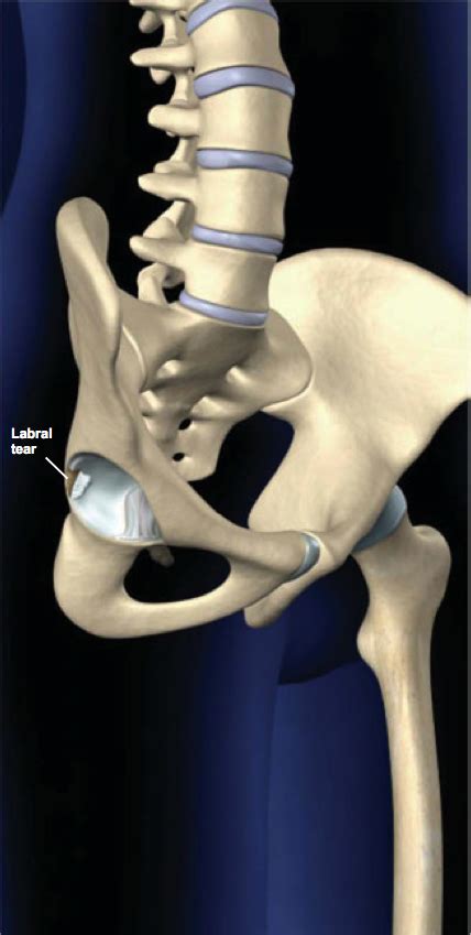 Hip Labral Tears Types