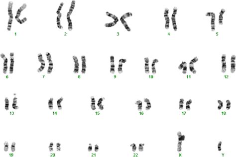 G Banding Karyogram Of Metaphase From The Patients Bone Marrow At Download Scientific Diagram