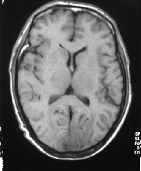 An Analysis Of The Magnetic Resonance Imaging And Pathology Of Intracal