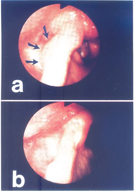 Figure 1 From Lymphoepithelial Cyst Of The Hypopharynx Semantic Scholar