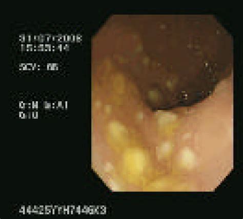 Endoscopy Showing A Classic Pseudomembranous Appearance With Multiple Download Scientific