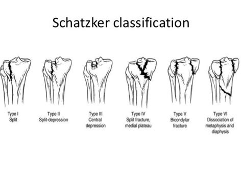 Management Of Tibial Plateau Fracture