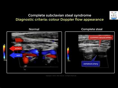 Subclavian Artery Ultrasound