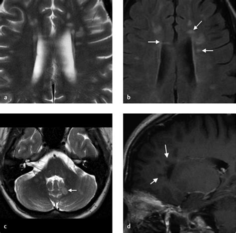 12 Diffuse White Matter Hyperintensities Radiology Key