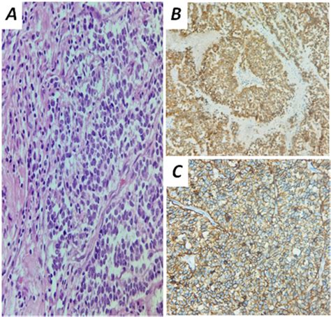 Figure A Histologic Sample Shows Solid Sheets Of Large Cells With