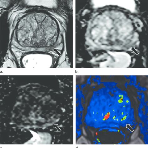 Prostate Sector Map AS Anterior Fibromuscular Stroma CZ Central