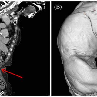 -SMV thrombosis in the elderly with kyphosis. (A) Contrast-enhanced ...