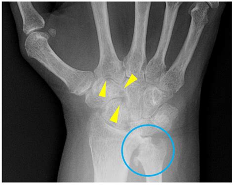 Radiographic Findings of Inflammatory Arthritis and Mimics in the Hands