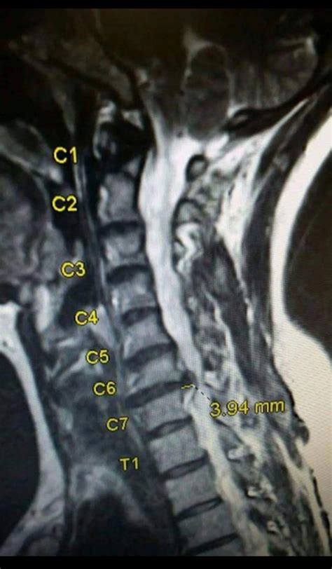 MRI of my critically compressed spinal cord before surgery : r/Radiology